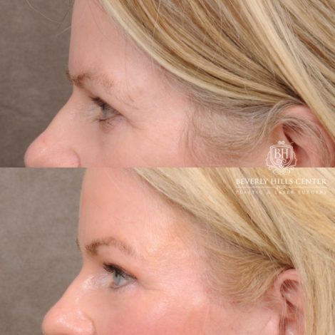 Beverly Hills Center Female Patient Before and After AuraLyft™, Cupid Lift®, Temporal Brow Reset, Lower Blepharoplasty, and Fat Grafting