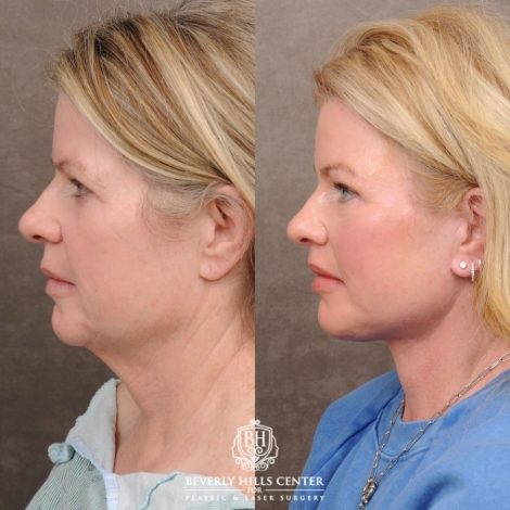 Beverly Hills Center Female Patient Before and After AuraLyft™, Cupid Lift®, Temporal Brow Reset, Lower Blepharoplasty, and Fat Grafting