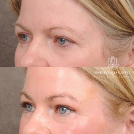 Beverly Hills Center Female Patient Before and After AuraLyft™, Cupid Lift®, Temporal Brow Reset, Lower Blepharoplasty, and Fat Grafting