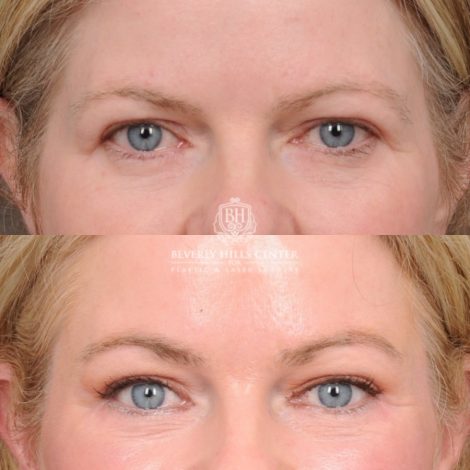 Beverly Hills Center Female Patient Before and After AuraLyft™, Cupid Lift®, Temporal Brow Reset, Lower Blepharoplasty, and Fat Grafting