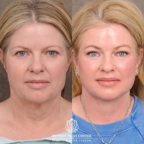 Beverly Hills Center Female Patient Before and After AuraLyft™, Cupid Lift®, Temporal Brow Reset, Lower Blepharoplasty, and Fat Grafting