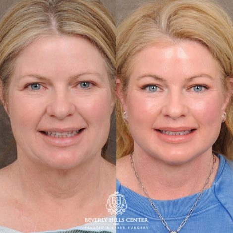 Beverly Hills Center Female Patient Before and After AuraLyft™, Cupid Lift®, Temporal Brow Reset, Lower Blepharoplasty, and Fat Grafting