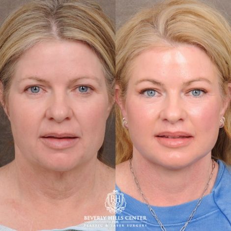 Beverly Hills Center Female Patient Before and After AuraLyft™, Cupid Lift®, Temporal Brow Reset, Lower Blepharoplasty, and Fat Grafting