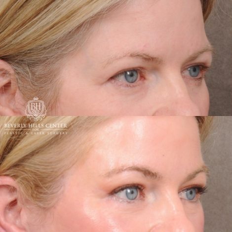 Beverly Hills Center Female Patient Before and After AuraLyft™, Cupid Lift®, Temporal Brow Reset, Lower Blepharoplasty, and Fat Grafting