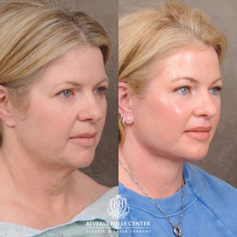 Beverly Hills Center Female Patient Before and After AuraLyft™, Cupid Lift®, Temporal Brow Reset, Lower Blepharoplasty, and Fat Grafting