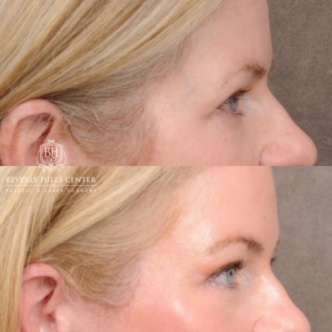 Beverly Hills Center Female Patient Before and After AuraLyft™, Cupid Lift®, Temporal Brow Reset, Lower Blepharoplasty, and Fat Grafting