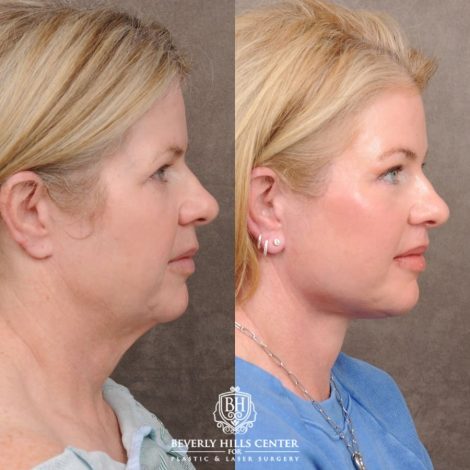 Beverly Hills Center Female Patient Before and After AuraLyft™, Cupid Lift®, Temporal Brow Reset, Lower Blepharoplasty, and Fat Grafting