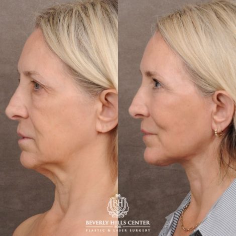 Beverly Hills Center Female Patient Before and After AuraLyft™, Temporal Brow Reset, Upper & Lower Blepharoplasty
