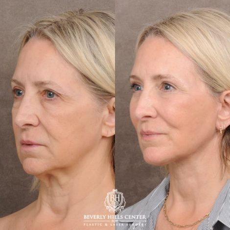 Beverly Hills Center Female Patient Before and After AuraLyft™, Temporal Brow Reset, Upper & Lower Blepharoplasty