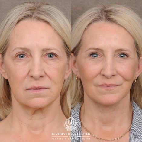 Beverly Hills Center Female Patient Before and After AuraLyft™, Temporal Brow Reset, Upper & Lower Blepharoplasty