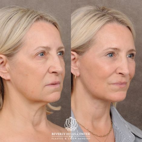 Beverly Hills Center Female Patient Before and After AuraLyft™, Temporal Brow Reset, Upper & Lower Blepharoplasty