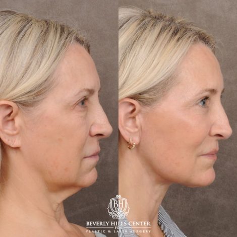 Beverly Hills Center Female Patient Before and After AuraLyft™, Temporal Brow Reset, Upper & Lower Blepharoplasty