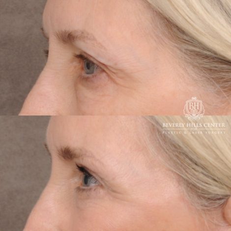 Beverly Hills Center Female Patient Before and After AuraLyft™, Temporal Brow Reset, Upper & Lower Blepharoplasty