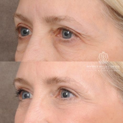 Beverly Hills Center Female Patient Before and After AuraLyft™, Temporal Brow Reset, Upper & Lower Blepharoplasty