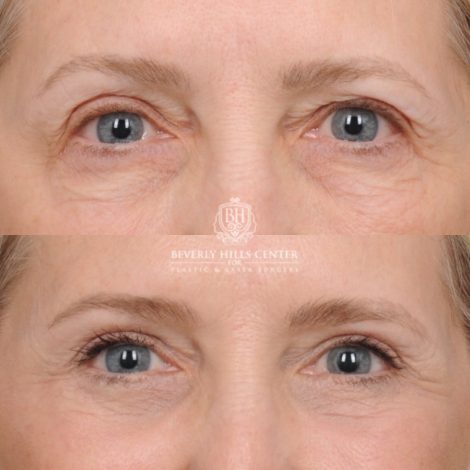 Beverly Hills Center Female Patient Before and After AuraLyft™, Temporal Brow Reset, Upper & Lower Blepharoplasty