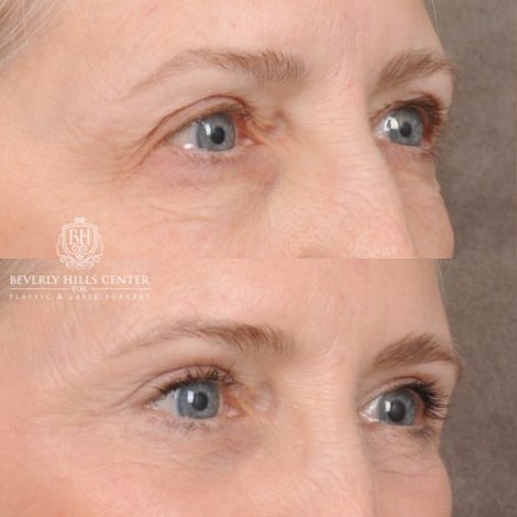 Beverly Hills Center Female Patient Before and After AuraLyft™, Temporal Brow Reset, Upper & Lower Blepharoplasty
