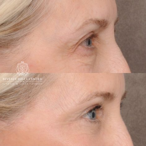 Beverly Hills Center Female Patient Before and After AuraLyft™, Temporal Brow Reset, Upper & Lower Blepharoplasty