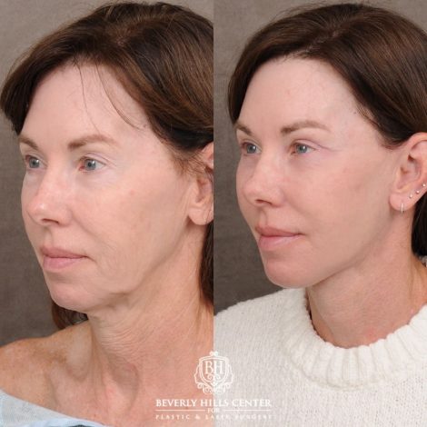 Beverly Hills Center Female Patient Before and After AuraLyft™, Temporal Brow Reset, Upper & Lower Blepharoplasty, Cupid Lift™ Corner Lift