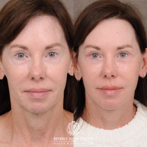 Beverly Hills Center Female Patient Before and After AuraLyft™, Temporal Brow Reset, Upper & Lower Blepharoplasty, Cupid Lift™ Corner Lift