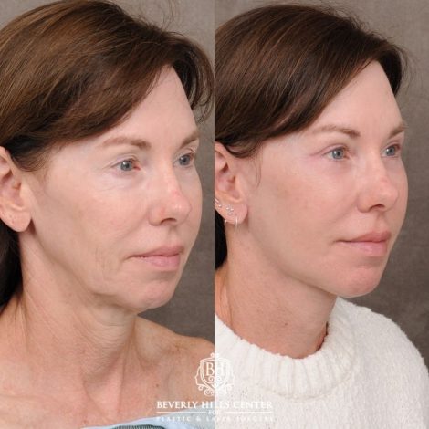 Beverly Hills Center Female Patient Before and After AuraLyft™, Temporal Brow Reset, Upper & Lower Blepharoplasty, Cupid Lift™ Corner Lift