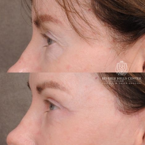 Beverly Hills Center Female Patient Before and After AuraLyft™, Temporal Brow Reset, Upper & Lower Blepharoplasty, Cupid Lift™ Corner Lift