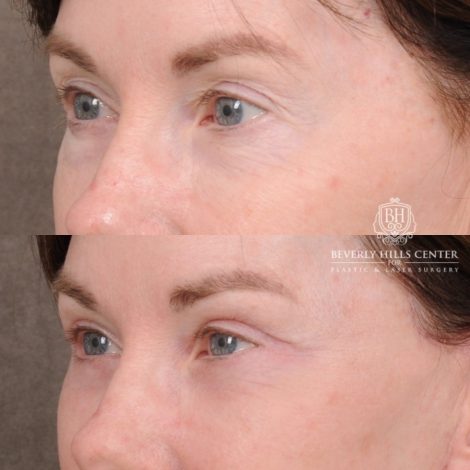 Beverly Hills Center Female Patient Before and After AuraLyft™, Temporal Brow Reset, Upper & Lower Blepharoplasty, Cupid Lift™ Corner Lift
