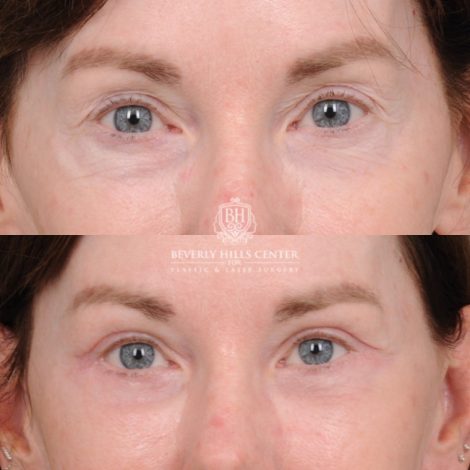 Beverly Hills Center Female Patient Before and After AuraLyft™, Temporal Brow Reset, Upper & Lower Blepharoplasty, Cupid Lift™ Corner Lift