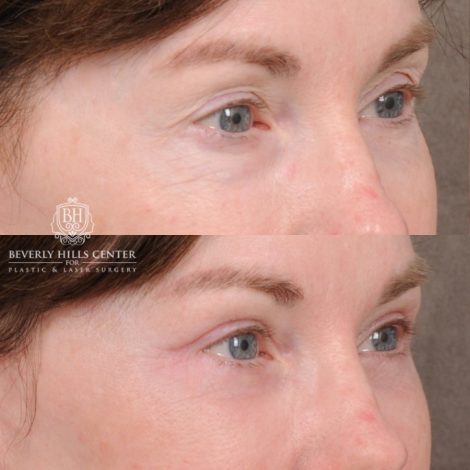 Beverly Hills Center Female Patient Before and After AuraLyft™, Temporal Brow Reset, Upper & Lower Blepharoplasty, Cupid Lift™ Corner Lift