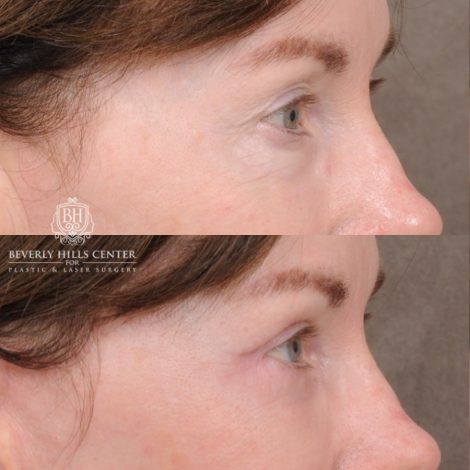 Beverly Hills Center Female Patient Before and After AuraLyft™, Temporal Brow Reset, Upper & Lower Blepharoplasty, Cupid Lift™ Corner Lift