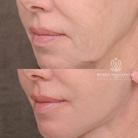 Beverly Hills Center Female Patient Before and After AuraLyft™, Temporal Brow Reset, Upper & Lower Blepharoplasty, Cupid Lift™ Corner Lift