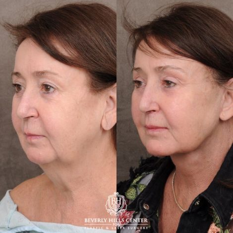 Beverly Hills Center Female Patient Before and After AuraLyft™, Cupid Lift®, Temporal Brow Reset, Fat Grafting