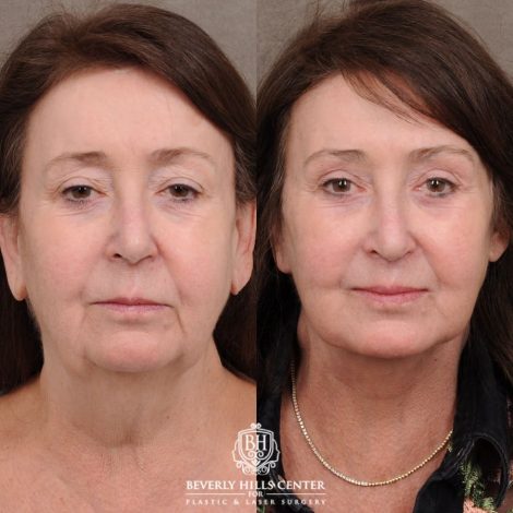 Beverly Hills Center Female Patient Before and After AuraLyft™, Cupid Lift®, Temporal Brow Reset, Fat Grafting