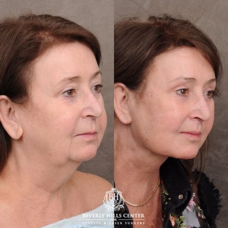 Beverly Hills Center Female Patient Before and After AuraLyft™, Cupid Lift®, Temporal Brow Reset, Fat Grafting
