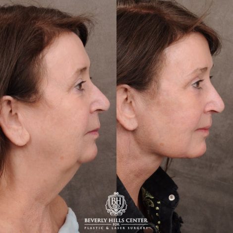 Beverly Hills Center Female Patient Before and After AuraLyft™, Cupid Lift®, Temporal Brow Reset, Fat Grafting