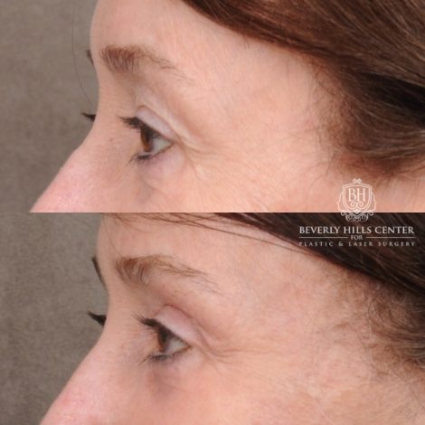 Beverly Hills Center Female Patient Before and After AuraLyft™, Cupid Lift®, Temporal Brow Reset, Fat Grafting