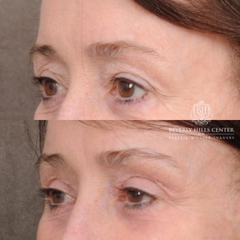 Beverly Hills Center Female Patient Before and After AuraLyft™, Cupid Lift®, Temporal Brow Reset, Fat Grafting