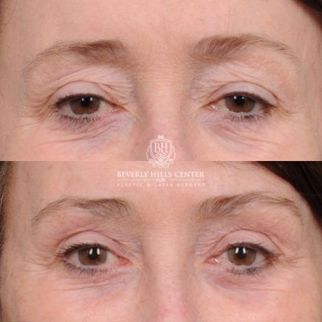 Beverly Hills Center Female Patient Before and After AuraLyft™, Cupid Lift®, Temporal Brow Reset, Fat Grafting