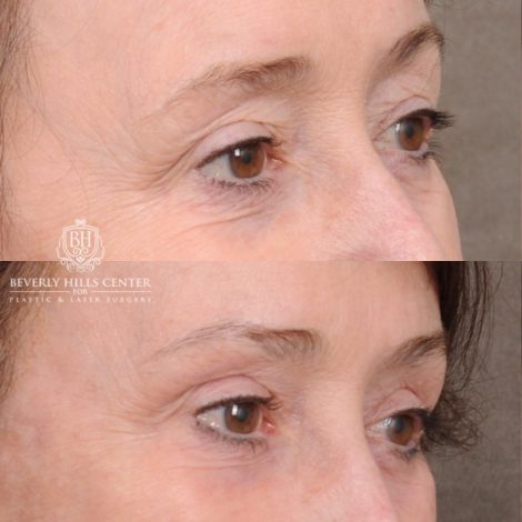 Beverly Hills Center Female Patient Before and After AuraLyft™, Cupid Lift®, Temporal Brow Reset, Fat Grafting