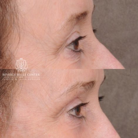 Beverly Hills Center Female Patient Before and After AuraLyft™, Cupid Lift®, Temporal Brow Reset, Fat Grafting