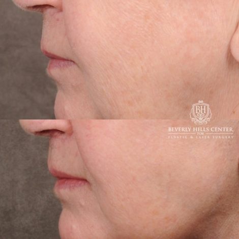 Beverly Hills Center Female Patient Before and After AuraLyft™, Cupid Lift®, Temporal Brow Reset, Fat Grafting