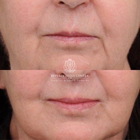 Beverly Hills Center Female Patient Before and After AuraLyft™, Cupid Lift®, Temporal Brow Reset, Fat Grafting