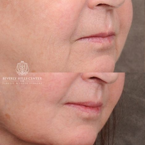 Beverly Hills Center Female Patient Before and After AuraLyft™, Cupid Lift®, Temporal Brow Reset, Fat Grafting
