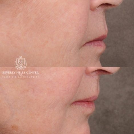 Beverly Hills Center Female Patient Before and After AuraLyft™, Cupid Lift®, Temporal Brow Reset, Fat Grafting