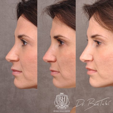Beverly Hills Center Female Patient Before and After Juvederm Migration & Edema, Dissolver & 3 Month Post Lip Lift