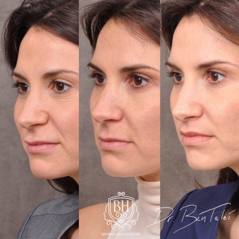 Beverly Hills Center Female Patient Before and After Juvederm Migration & Edema, Dissolver & 3 Month Post Lip Lift