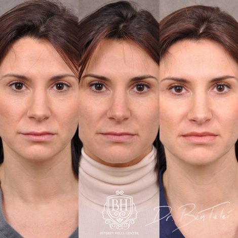 Beverly Hills Center Female Patient Before and After Juvederm Migration & Edema, Dissolver & 3 Month Post Lip Lift