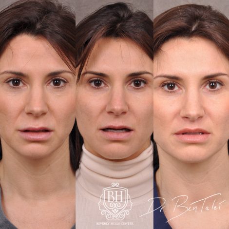 Beverly Hills Center Female Patient Before and After Juvederm Migration & Edema, Dissolver & 3 Month Post Lip Lift