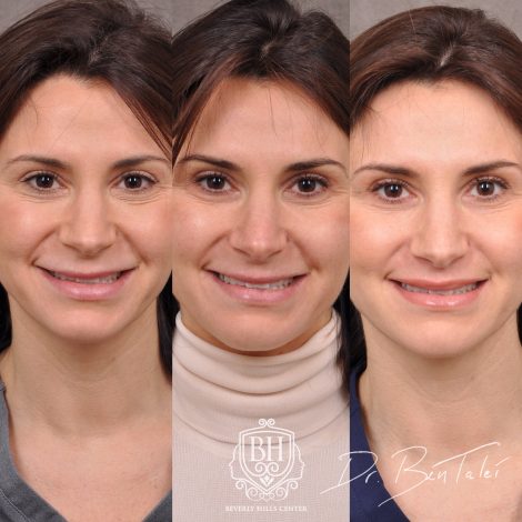 Beverly Hills Center Female Patient Before and After Juvederm Migration & Edema, Dissolver & 3 Month Post Lip Lift