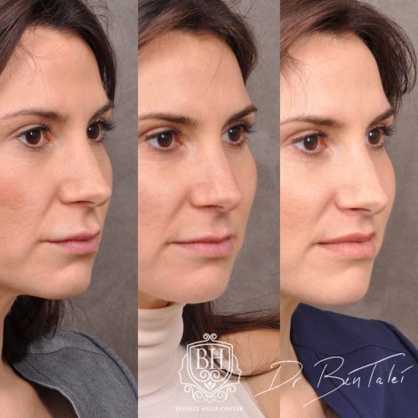 Beverly Hills Center Female Patient Before and After Juvederm Migration & Edema, Dissolver & 3 Month Post Lip Lift