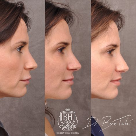 Beverly Hills Center Female Patient Before and After Juvederm Migration & Edema, Dissolver & 3 Month Post Lip Lift